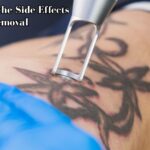 Navigating the Side Effects of Tattoo Removal