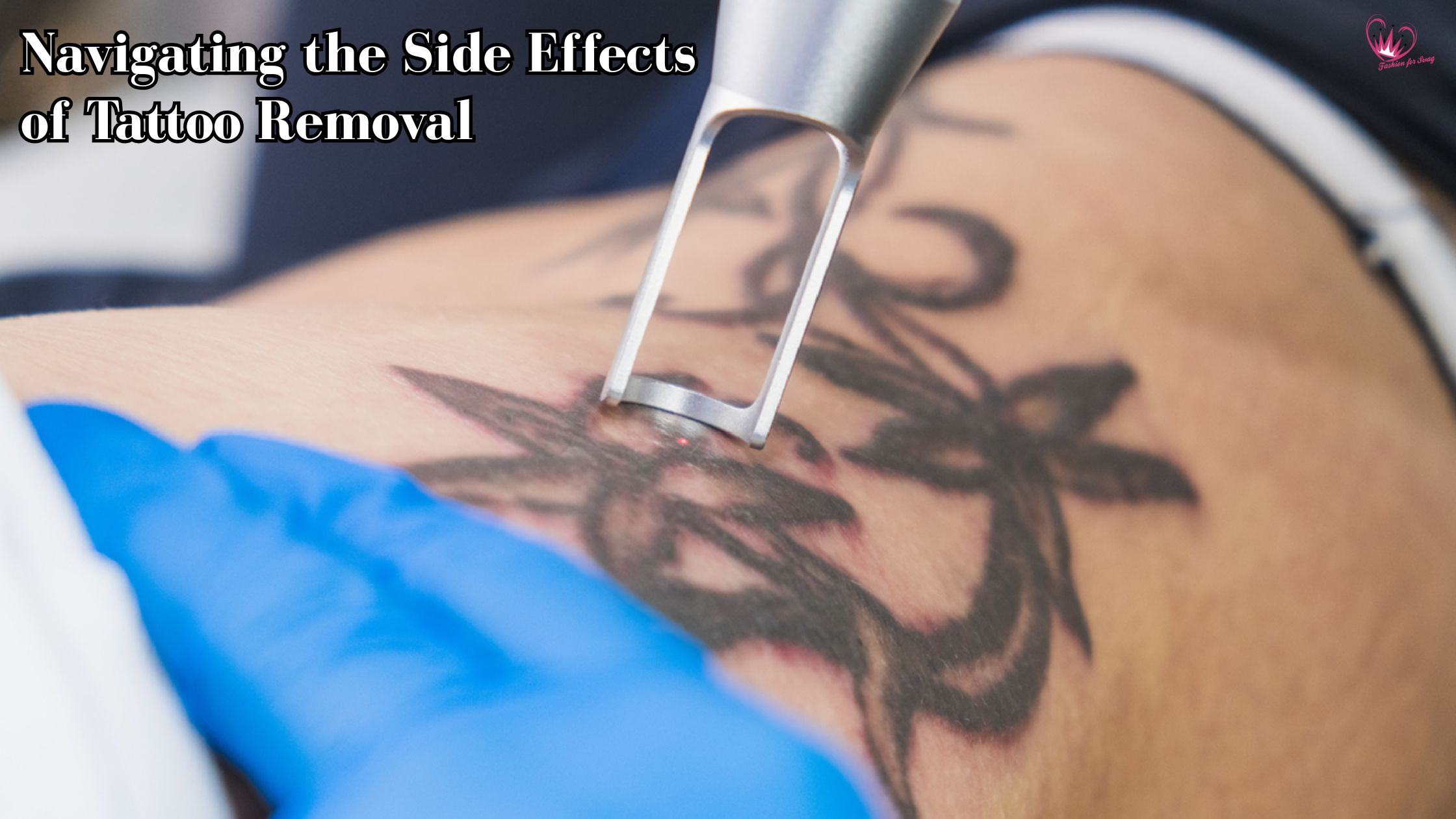 Navigating the Side Effects of Tattoo Removal